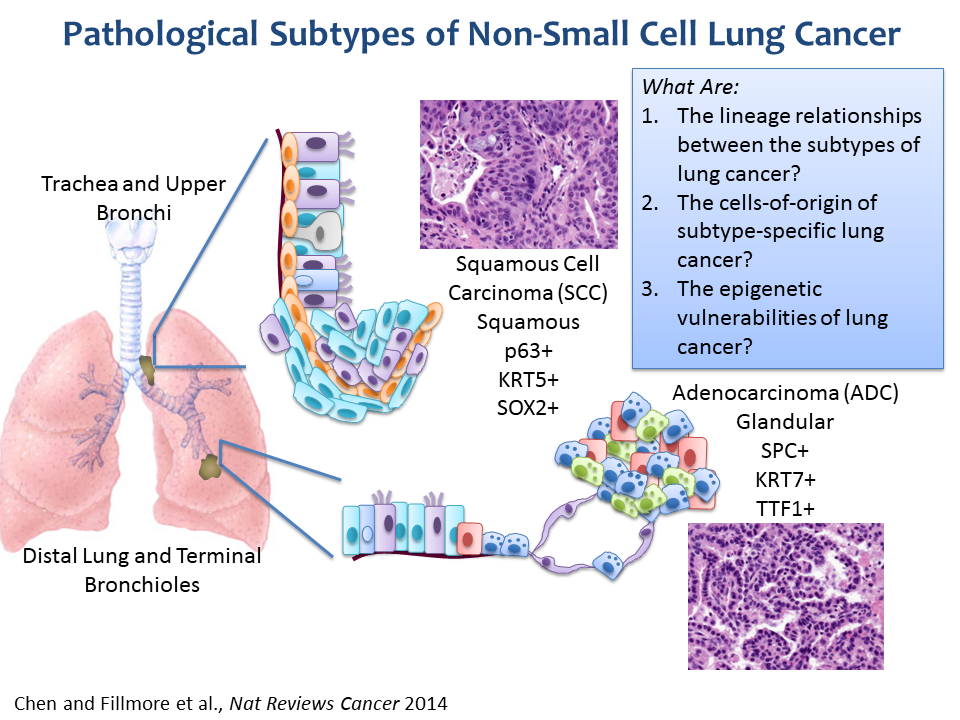 Pathological Subtypes of Non-Small Cell Lung Cancer
